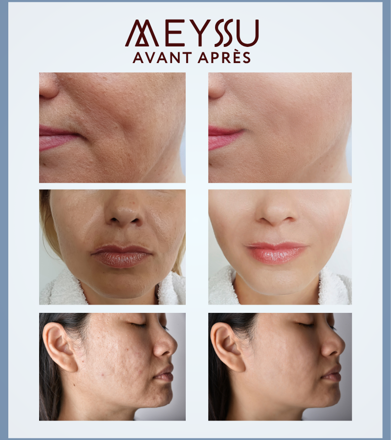 Pack jeunesse E-book et Microneedling